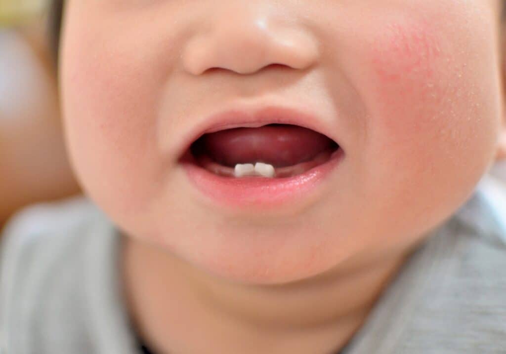 歯が生える赤ちゃんを落ち着かせるための治療法と治療法