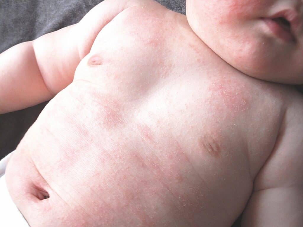 新生児ニキビ以外の赤ちゃんの湿疹